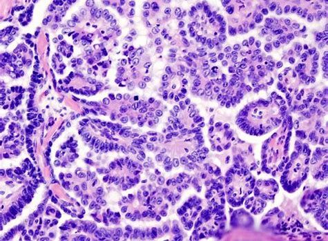 CancerRes：新研究发现帮助清除癌症干细胞的新靶标