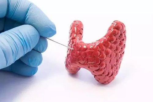 甲状腺疾病，包括甲状腺功能减退和甲状腺功能亢进，自古以来就是反复被医学研究人员研究的疾病